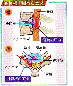 図（頚椎椎間板ヘルニア）