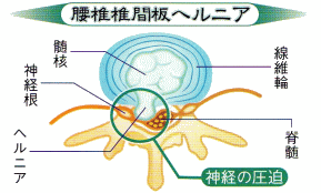図（腰椎椎間板ヘルニア）