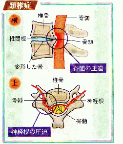 図（頚椎症）