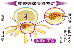 図（腰部脊柱管狭窄症）
