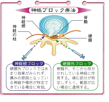 図（神経ブロック療法）