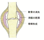 イラスト（変形性膝関節症２）